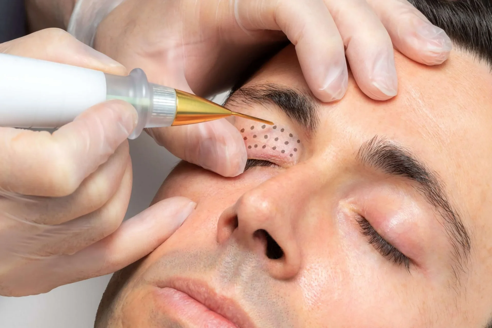 Fibroblast plasma skin tightening at Essential SkinCare Body Spa in Bonita Springs, Florida